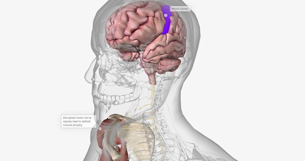 La esclerosis lateral amiotrópica ELA es un trastorno neurodegenerativo progresivo causado por la muerte de las neuronas motoras