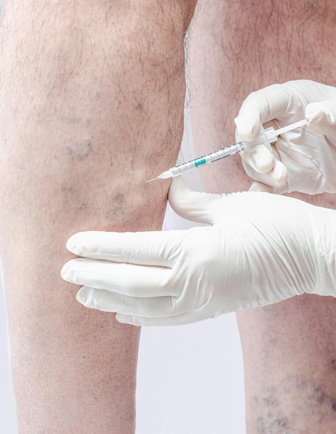 Escleroterapia nas pernas de um homem adulto caucasiano.