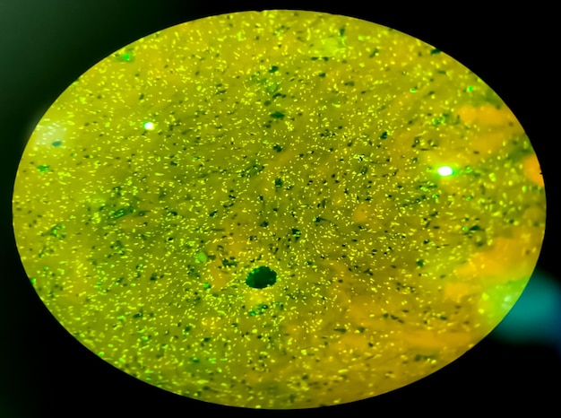 Esfregaço de escarro Fluorescência (FM) coloração microscópica 40x mostra abundância de Macrobacterium Tuberculosis MTB.