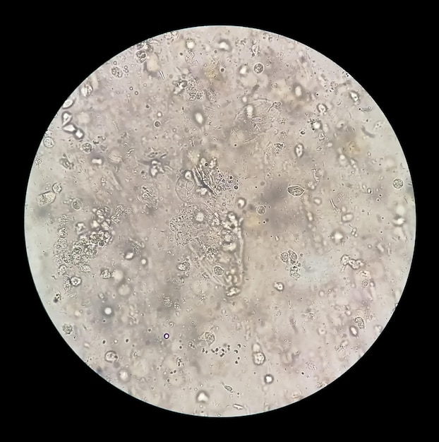 Esfregaço de esputo sem mancha sob microscopia mostrando células de pus