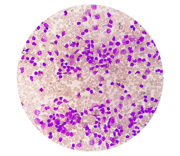 Esfregaço de sangue sob microscopia mostrando leucemia linfoblástica crônica (LLC)