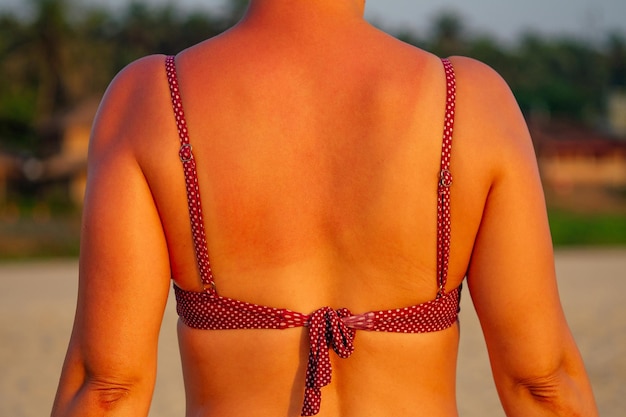 Espalda carbonizada en traje de baño contra el mar.