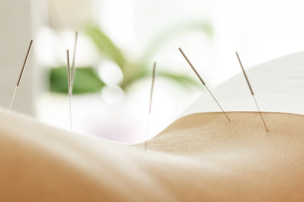 Foto espalda femenina con agujas de acero durante el procedimiento de terapia de acupuntura