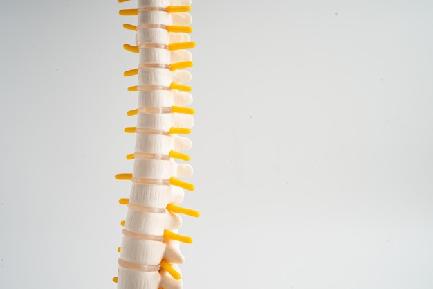 Foto espina lumbar desplazada fragmento de disco herniado nervio espinal y hueso modelo de tratamiento médico en el departamento ortopédico