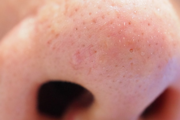 Espinha e acne na pele e no nariz da cara, macro do zumbido. Pele de poros oleosa.