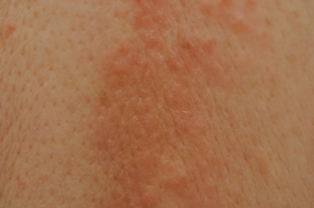 Espinhas de eczema nas costas