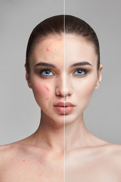 Espinillas y acné en rostro de mujer antes y después.