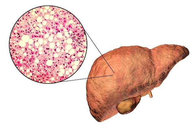 Esteatose hepática de fígado gordo ilustração 3d e fotomicrografia mostrando grandes vacúolos de gordura triglicérida acumulados dentro das células do fígado ocorre no uso excessivo de álcool sob a ação de toxinas