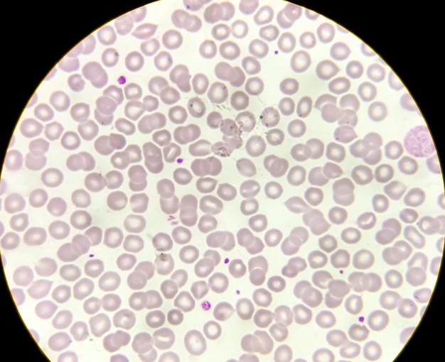 Estomatócitos analisados por microscópio. Os glóbulos vermelhos são semelhantes a fendas, palidez central da boca de peixe.