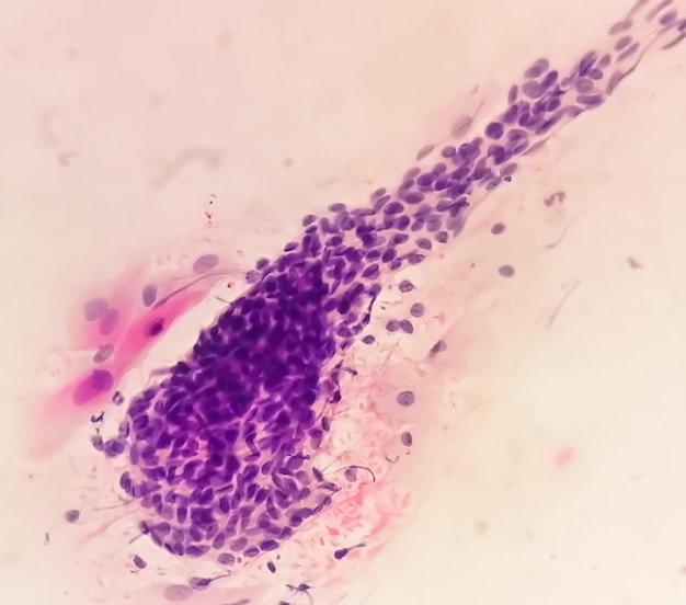 Estudio de frotis PAPS de una mujer joven bajo microscopía que muestra cambios atróficos en el útero