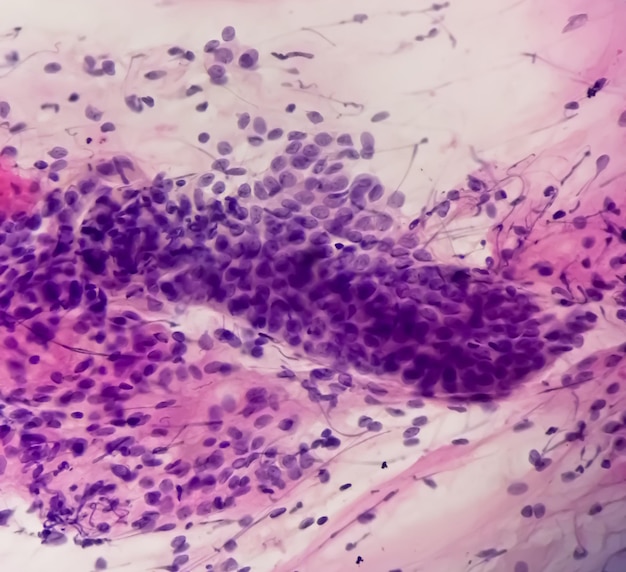 Estudo de esfregaço PAPS de uma mulher jovem sob microscopia mostrando alterações atróficas no útero