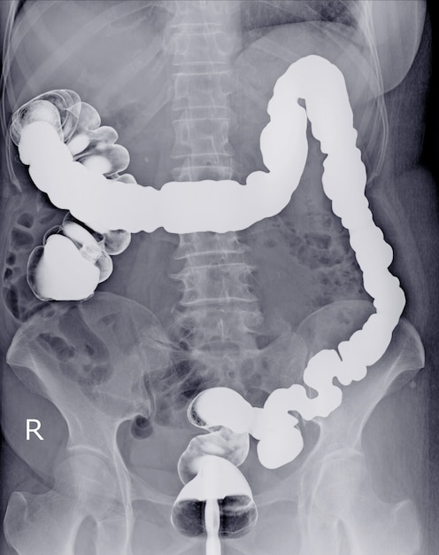 Examen especial Bario enema A Hembra