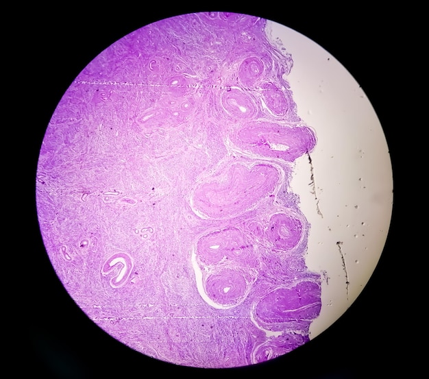 Examen histológico de biopsia de útero sugestiva de prolapso uterino. Prolapso cervical crónico.