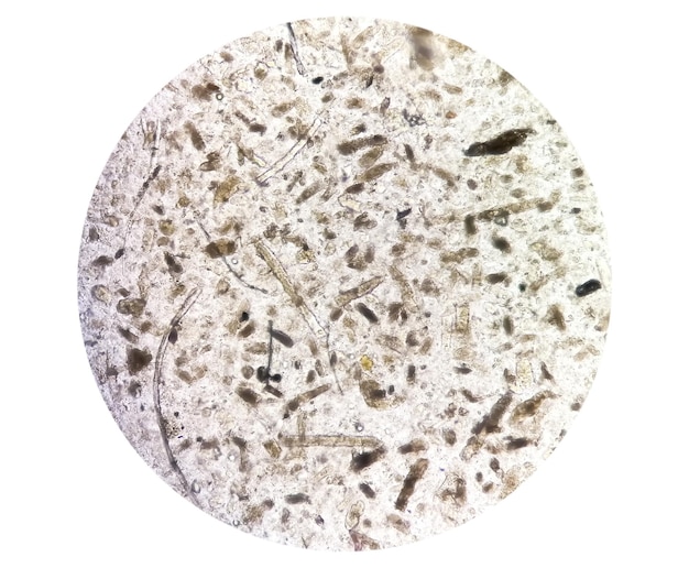 Examen microscópico de orina que muestra yeso granular, un signo de muchos tipos de enfermedades renales.