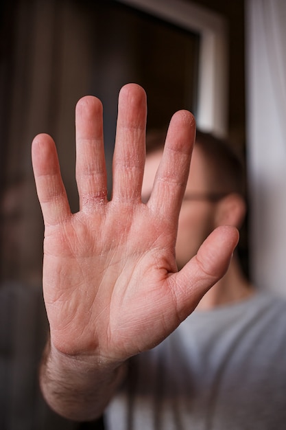 Exfoliación de manos muy seca debido al lavado con alcohol