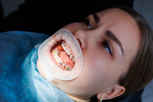 Extensor para dientes. Dientes de una mujer con aparatos ortopédicos en una cita con el dentista. Tratamiento de ortodoncia de la distorsión dental. Primer plano, enfoque selectivo. Frenos en los dientes