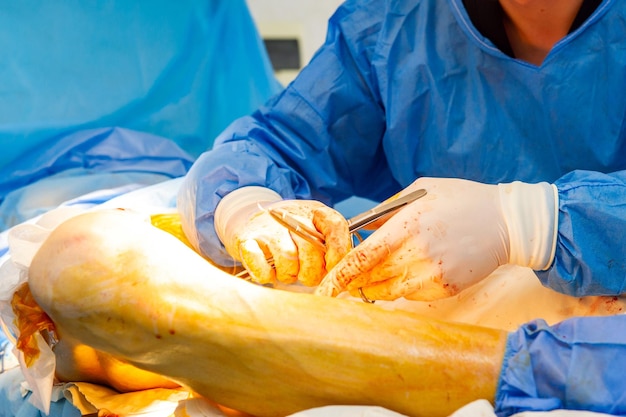 Feche a mão do médico enquanto cirurgião e assistente realizando cirurgia na equipe médica usando vários instrumentos cirúrgicos na sala de cirurgia