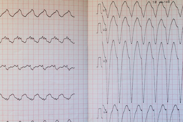 Feche acima da ideia de um papel do eletrocardiograma.