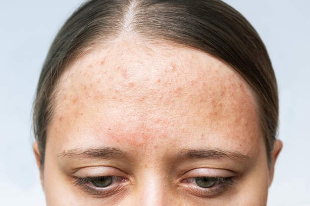 Foto feche de erupção alérgica vermelha na testa. foto recortada do rosto da jovem com problema de acne