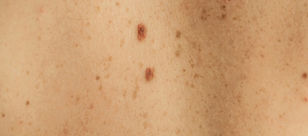 Foto feche detalhes da pele nua nas costas de um homem com manchas e sardas espalhadas. verificando manchas benignas