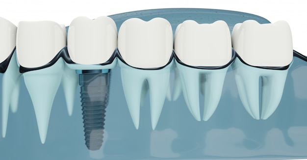 Feche o componente de implantes dentários. cor azul transparente. ilustrações 3d