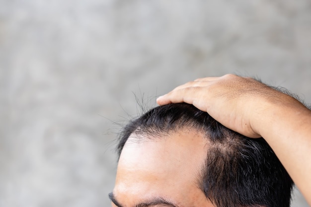 Feche o homem tocando sua cabeça para mostrar a cabeça careca ou o problema de Glabrous.