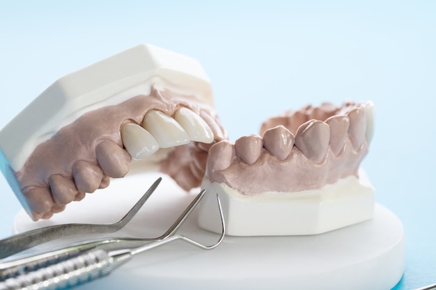 Ferramenta dentária e odontológica - modelo de dentes de demonstração de variância de dentes porstodônticos