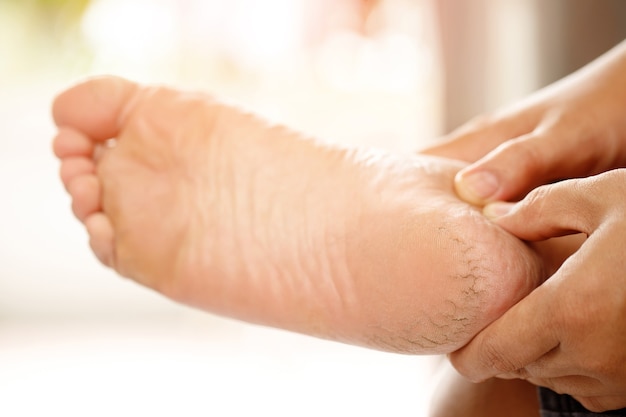 Fersenrissbehandlung Die Fußcreme sollte regelmäßig aufgetragen werden. Reiben und massieren Sie die Fersen, damit die Creme gut einzieht. Hilft der Haut der Füße Feuchtigkeit zuzuführen