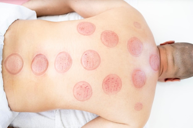 Feuchte Schnitte und Schnitte auf dem Patienten nach der Hijama-Behandlung