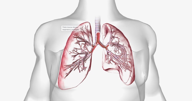 La fibrosis quística es una enfermedad genéticamente heredada que afecta a las células secretoras de todo el cuerpo.