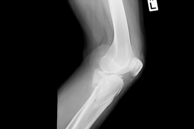 Film Röntgenbild linkes Knie. Röntgenaufnahme des linken Knies des 51-jährigen asiatischen Mannes von der Seite.