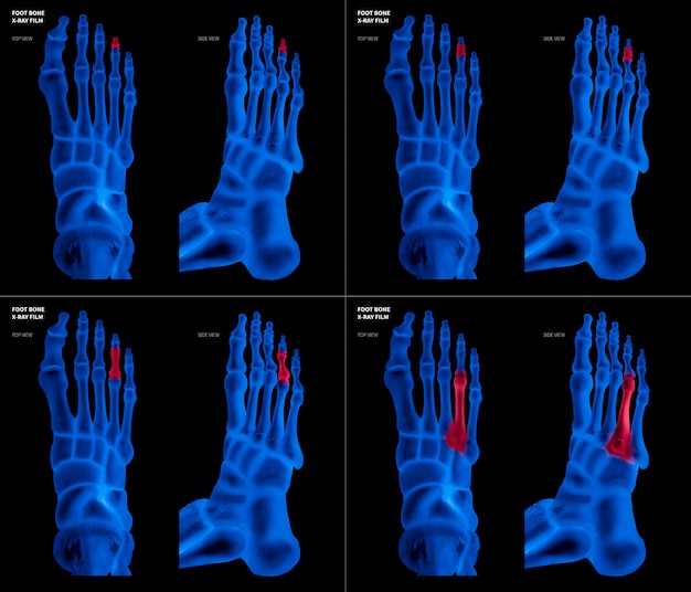 Foto filme de raio x azul do osso do pé do dedo do pé do anel com destaques vermelhos na dor e na área comum diferentes