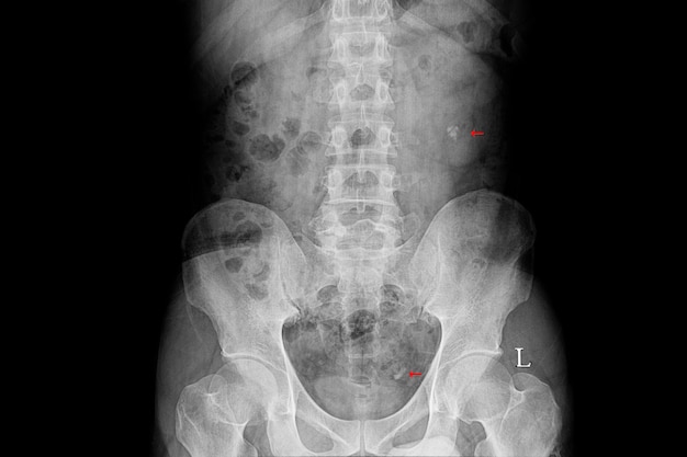 Filme de raio X de um paciente com cálculos renais e uretrais