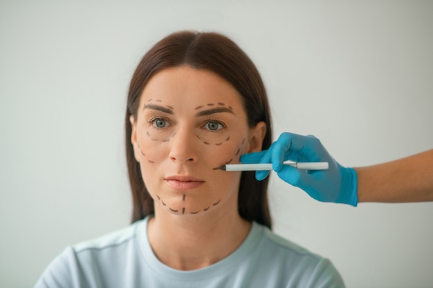Una foto en la cabeza de una mujer con líneas para procedimientos de estiramiento facial
