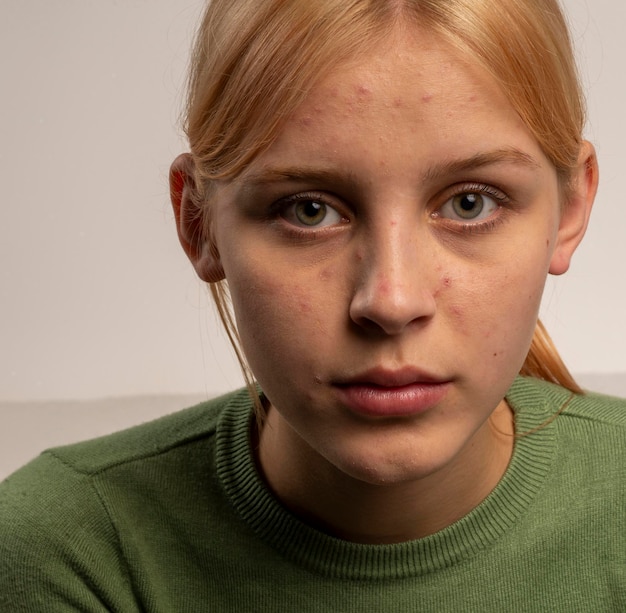foto de uma bela garota de 18 anos com cabelo loiro e acne em um fundo claro