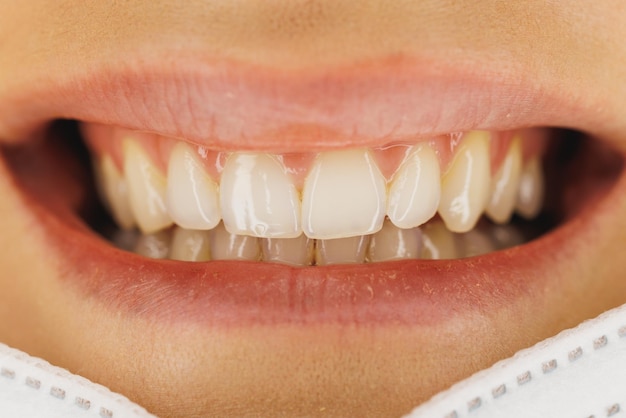 Foto de uma mulher irreconhecível sorrindo brilhantemente com os dentes antes de fazer o ortodontista ou o trabalho odontológico.