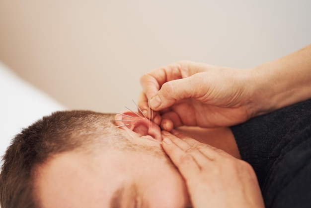 Una foto de un hombre con acupuntura en la oreja.