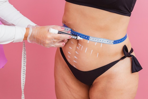 Foto de primer plano realizando mediciones en el abdomen del paciente para realizar un procedimiento estético