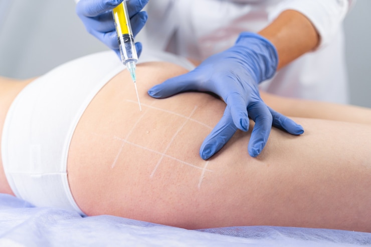 Foto foto recortada de una cosmetóloga profesional con guantes que realiza un procedimiento de mesoterapia para la celulitis