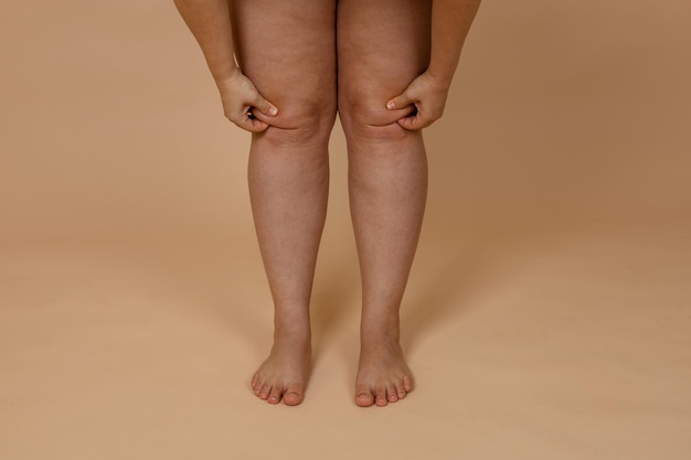 Foto recortada de mulher de pernas nuas beliscando gordura nos joelhos Cortando dobras de gordura Pele grossa desidratada Perda de gordura local