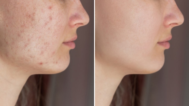 Foto foto recortada do rosto de uma jovem antes e depois do tratamento da acne no rosto erupção de espinhas nas bochechas