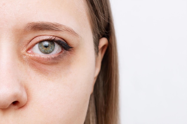 Foto foto recortada do rosto de uma jovem mulher caucasiana com círculo escuro sob os olhos contusões de pele pálida sob os olhos