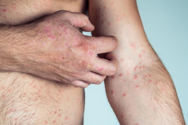 Foto recortada de un hombre semidesnudo que sufre de psoriasis y se rasca la piel del brazo con racimos gruesos y escamosos