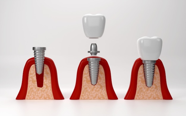 Foto Zahnimplantate Chirurgie 3D-Rendering