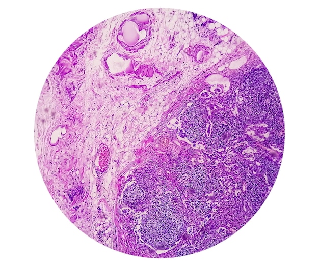 Fotomicrografia de adenocarcinoma de estômago. Adenocarcinoma Gástrico.