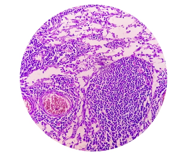 Fotomicrografia de adenocarcinoma de estômago. Adenocarcinoma Gástrico.