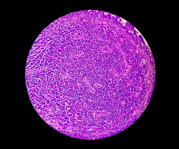 Fotomicrografia de carcinoma endometrial ou câncer para o conceito de conscientização do câncer endometrial