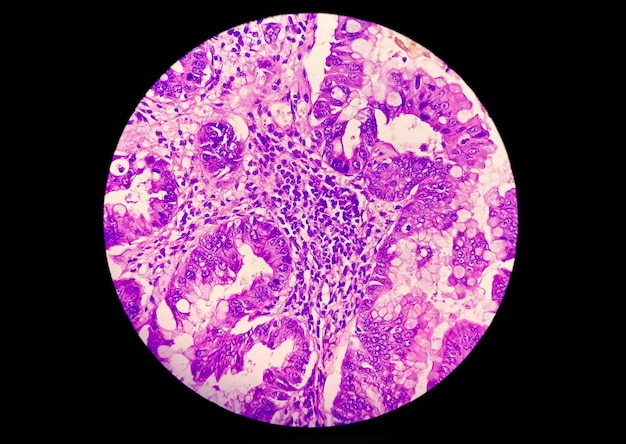 Foto fotomicrografia mostrando adenocarcinoma um conceito de conscientização do câncer