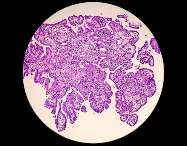 Fotomicrografia mostrando adenocarcinoma um conceito de conscientização do câncer