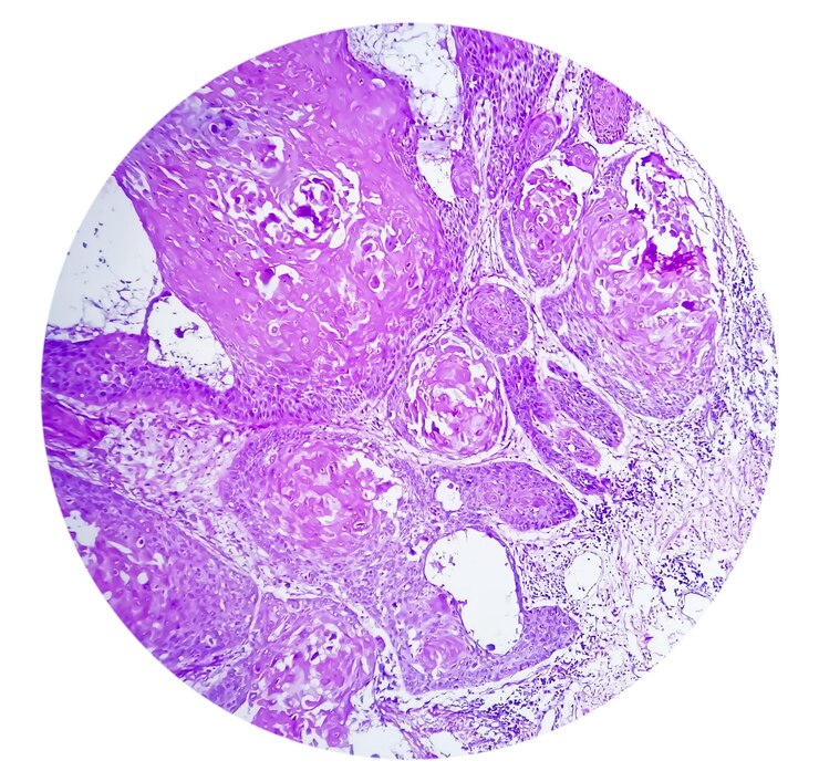 Foto fotomicrógrafo de carcinoma invasivo de células escamosas del pezón de grado ii